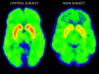 Adhd Brain Stimuli Activity Works